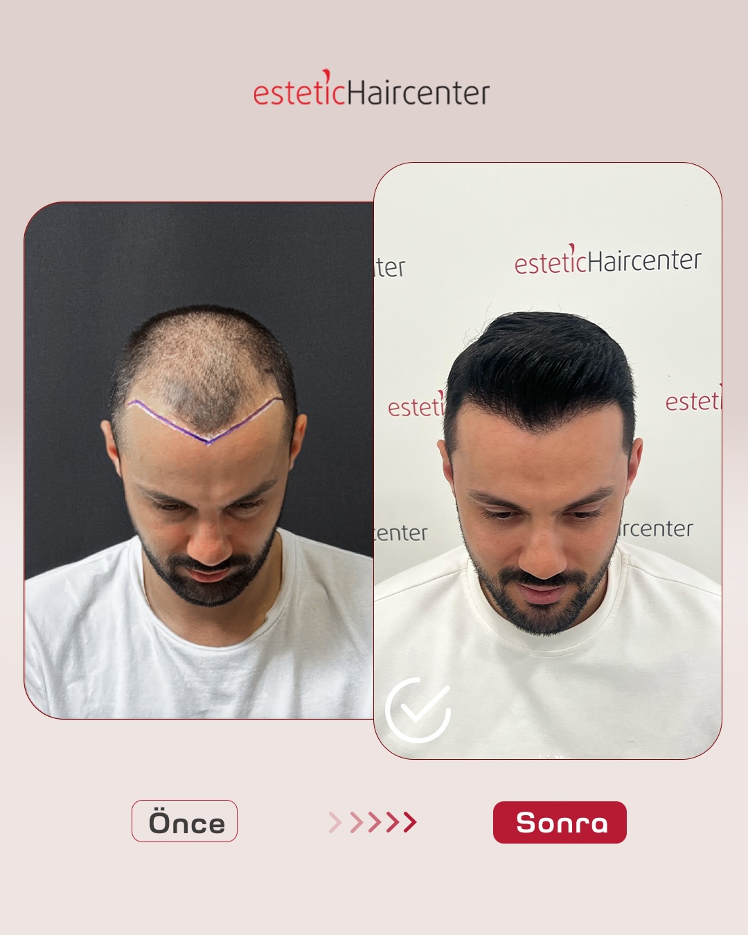 Bursa saç ekimi FUE tekniği öncesi sonrası - 6. ay sonucu Estetic Hair Center Nilüfer