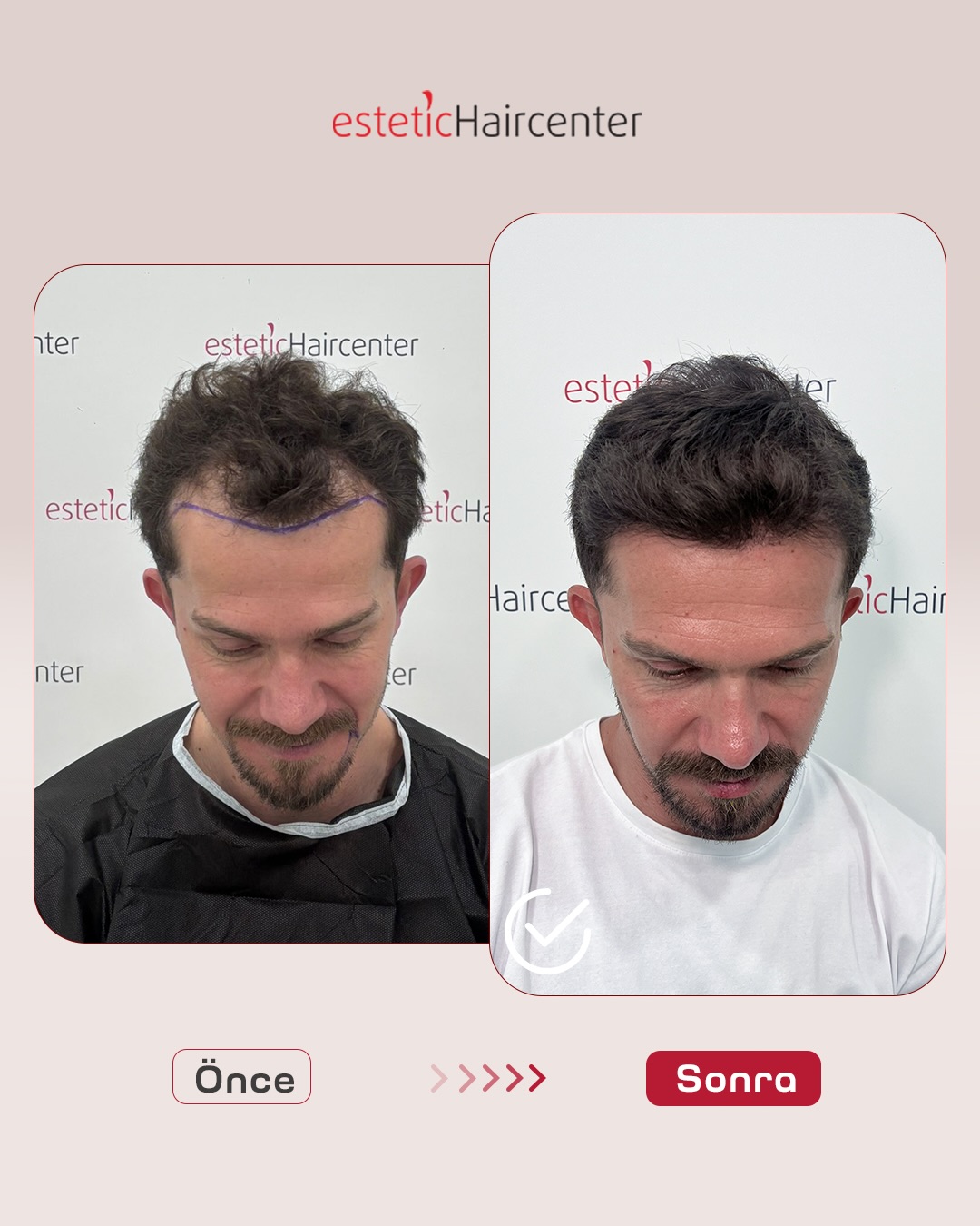Bursa saç ekimi öncesi sonrası - 7. ay doğal sonuç Estetic Hair Center Nilüfer