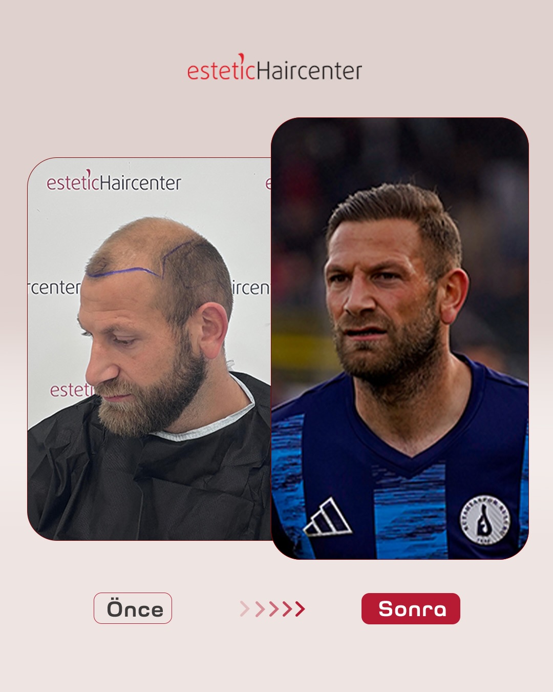 Bursa saç ekimi öncesi sonrası 2. hasta - 9. ay sonucu Estetic Hair Center Nilüfer