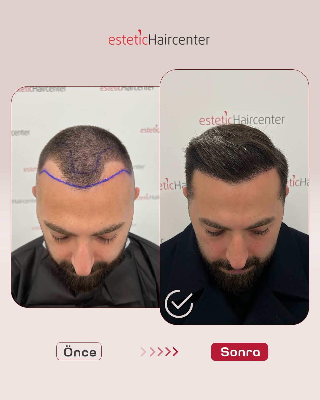 Bursa saç ekimi FUE öncesi sonrası - 9. ay kalıcı sonuç Estetic Hair Center